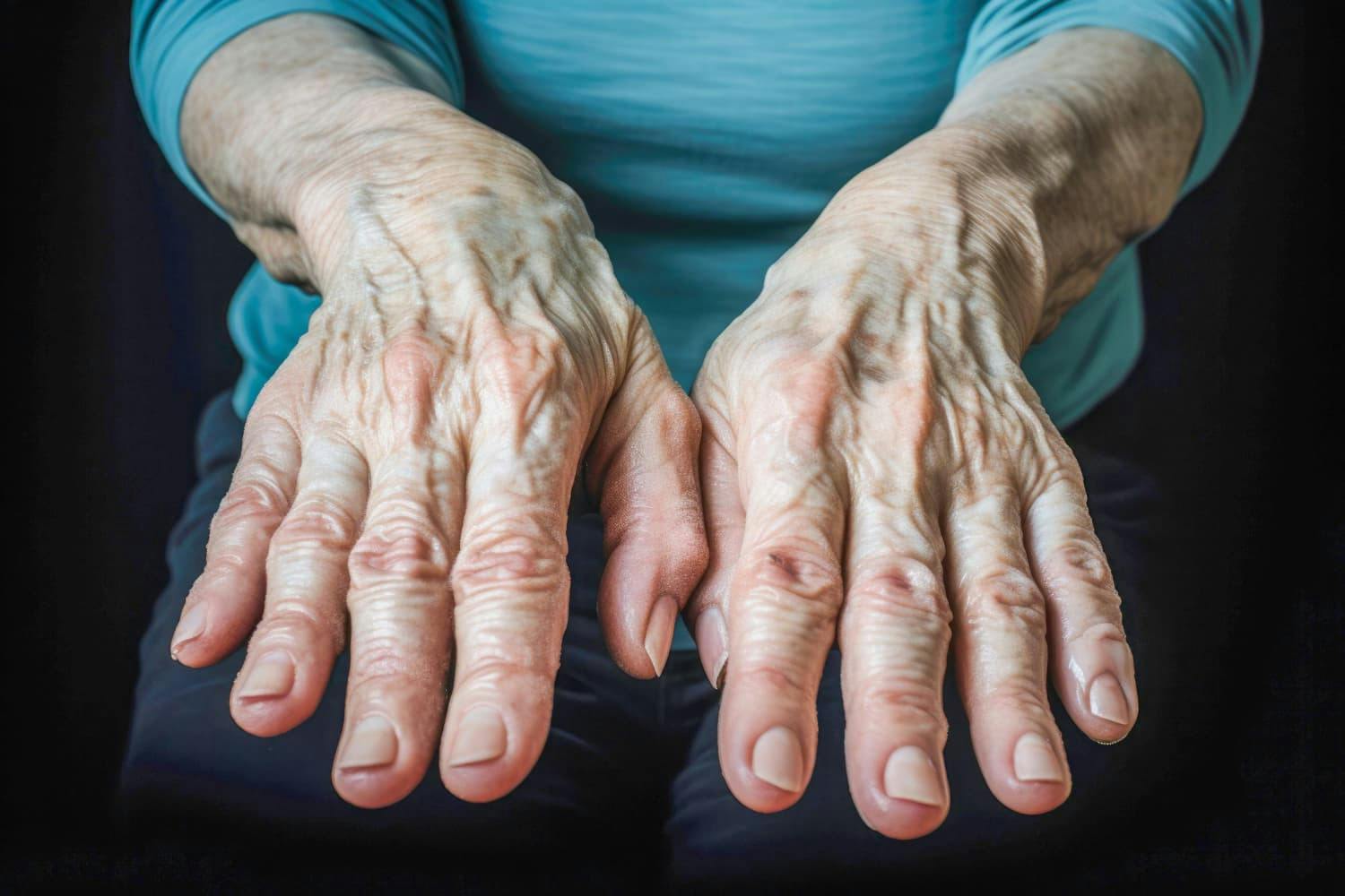 Afbeelding voor Artritis en Ergotherapie: Leven met Gewrichtsontsteking
